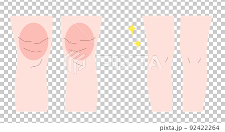 Illustration material of a woman with thick legs and a woman with thin legs Illustration material of a woman with thick legs and a woman with thin legs 92422264