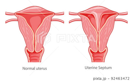 Set of Uterine septum septate uterus Female reproductive system diagram normal and with disease pain. Front view in cut 92463472