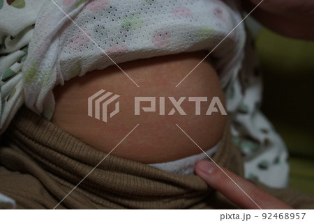 突発性発疹 突発性発疹 92468957