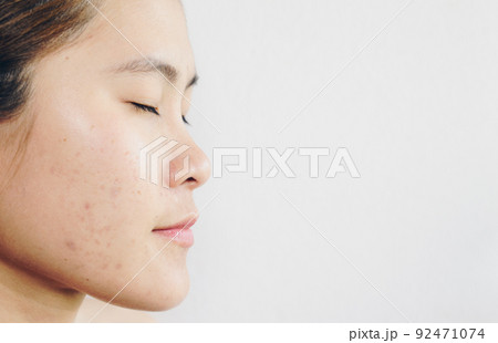 Half face of Asian woman has problems with skin on her face. Conceptual shot of problems with acne and scar on the female skin. Half face of Asian woman has problems with skin on her face. Conceptual shot of problems with acne and scar on the female skin. 92471074