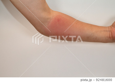 アシナガバチに刺された翌日に赤く腫れあがった男性の腕 92481600