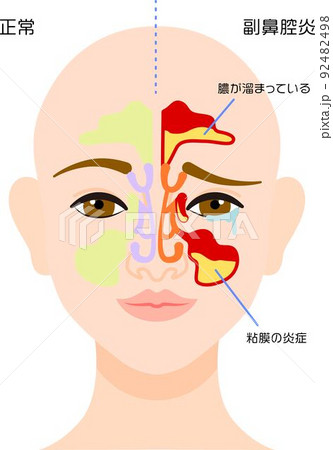 副鼻腔炎の症状を図解した素材 92482498