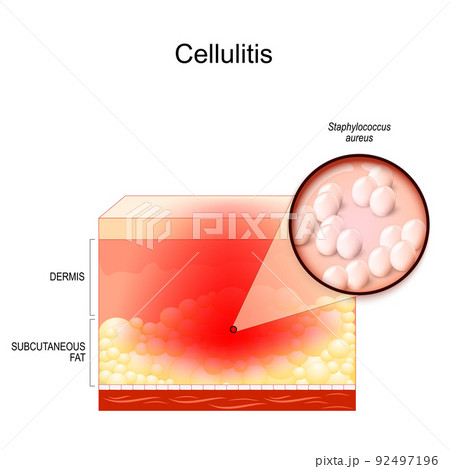 cellulitis. Cross section of layers of the human Skin with symptoms of Infectious disease 92497196