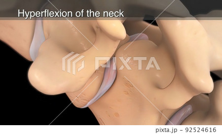 hyperflexion of the neck 3d 92524616