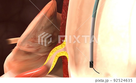 coronary angiography procedures 3d 92524635