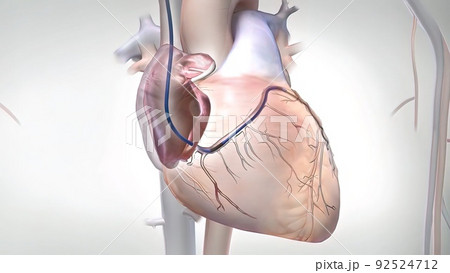A surgical procedure to reduce the risk of death, Coronary Artery Bypass Graft A surgical procedure to reduce the risk of death, Coronary Artery Bypass Graft 92524712