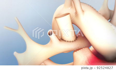 The Cardiovascular system. Hypoplastic left heart syndrome The Cardiovascular system. Hypoplastic left heart syndrome 92524827
