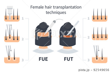 Female hair transplantation FUE and FUT infographic 92549656
