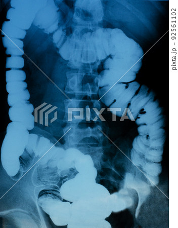An X-ray of the intestine. The concept of diagnosis and treatment of diseases An X-ray of the intestine. The concept of diagnosis and treatment of diseases 92561102