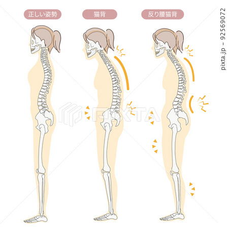 正しい姿勢と猫背・反り腰など悪い姿勢の骨格がわかりやすい横向きのイラスト 正しい姿勢と猫背・反り腰など悪い姿勢の骨格がわかりやすい横向きのイラスト 92569072