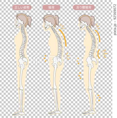 正しい姿勢と猫背・反り腰など悪い姿勢の骨格がわかりやすい横向きのイラスト 正しい姿勢と猫背・反り腰など悪い姿勢の骨格がわかりやすい横向きのイラスト 92569072