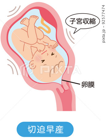 切迫早産　子宮の中の赤ちゃん　妊娠中の母体の仕組み 92577474