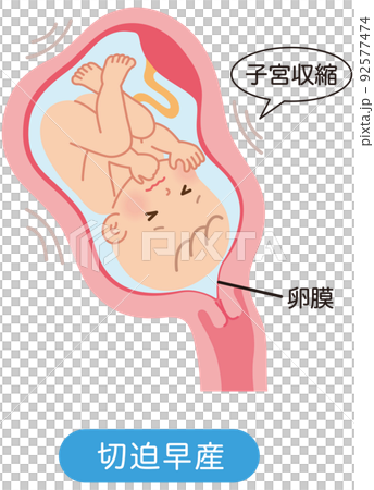 切迫早産　子宮の中の赤ちゃん　妊娠中の母体の仕組み 92577474