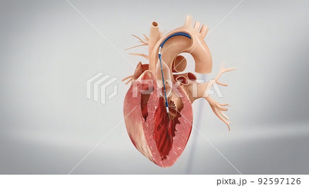 Coronary angioplasty and stent insertion 92597126