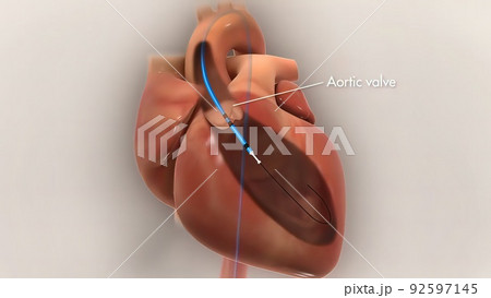 heart stent insertion process 92597145