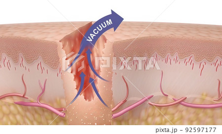 3D Medical illustration of healing time of skin wounds 3D Medical illustration of healing time of skin wounds 92597177