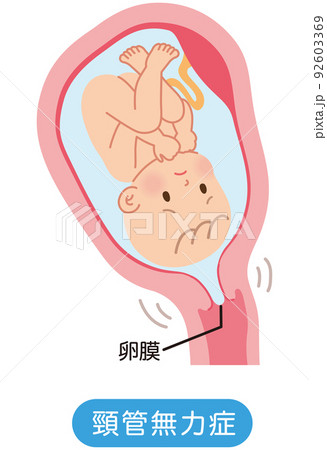 頸管無力症　子宮の中の赤ちゃん　妊娠中の母体の仕組み 92603369