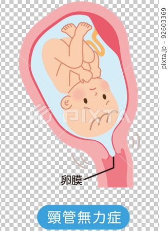 頸管無力症　子宮の中の赤ちゃん　妊娠中の母体の仕組み 92603369