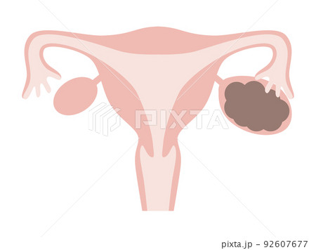 チョコレート嚢胞 チョコレート嚢胞 92607677