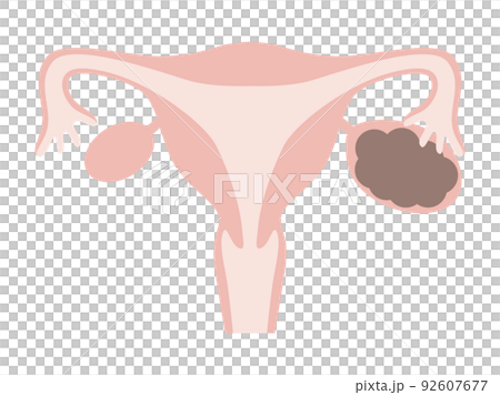 チョコレート嚢胞 チョコレート嚢胞 92607677