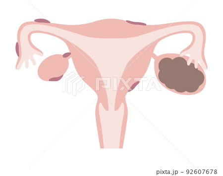 チョコレート嚢胞と子宮内膜症 92607678