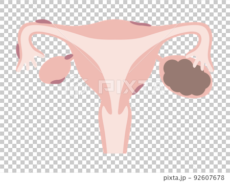 チョコレート嚢胞と子宮内膜症 92607678