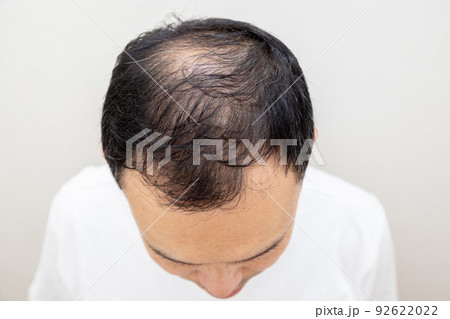 薄毛に悩む中年男性 92622022