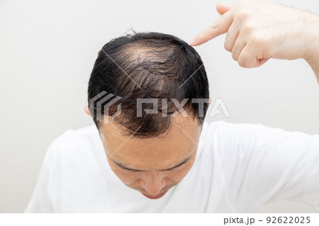 薄毛に悩む中年男性 薄毛に悩む中年男性 92622025