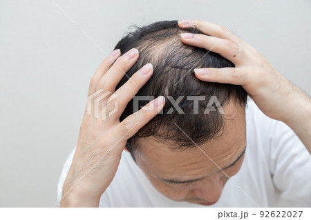 薄毛に悩む中年男性 92622027