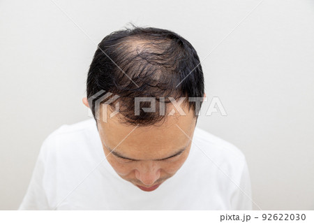 薄毛に悩む中年男性 92622030