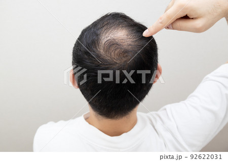 薄毛に悩む中年男性 薄毛に悩む中年男性 92622031