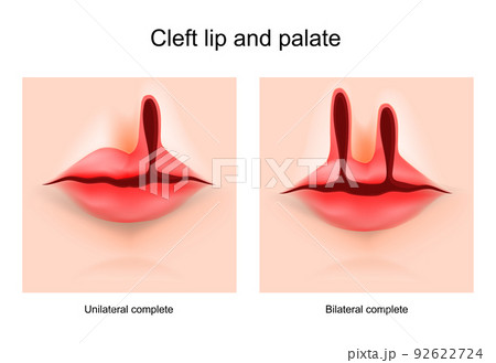 Cleft lip and cleft palate 92622724