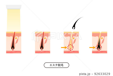 脱毛のイメージ、エステ脱毛を施術してから毛が抜ける流れ 92633029