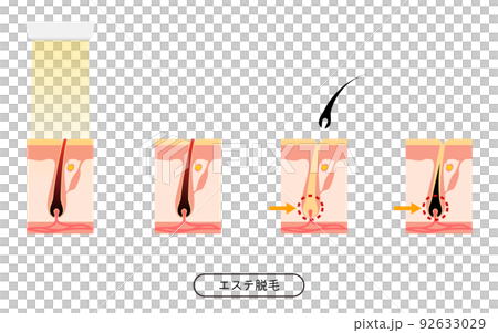 脱毛のイメージ、エステ脱毛を施術してから毛が抜ける流れ 92633029