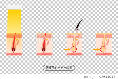 Image of hair removal, flow of hair loss after medical laser hair removal treatment Image of hair removal, flow of hair loss after medical laser hair removal treatment 92633031