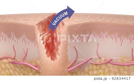 3D Medical illustration of healing time of skin wounds 92634417