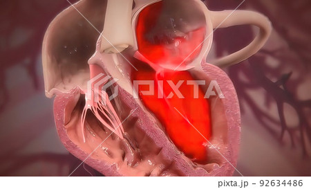 Heart muscle disease in human body 92634486