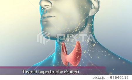 Hyperthyroidism is when the thyroid gland produces more thyroid hormone than your body needs. Hyperthyroidism is when the thyroid gland produces more thyroid hormone than your body needs. 92646115