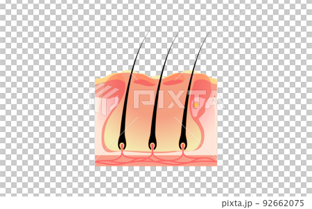 Illustrative illustration of ``you'' in which multiple folliculitis exacerbated folliculitis are connected subcutaneously 92662075