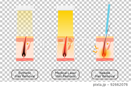 Image of hair removal, esthetic hair removal, medical laser hair removal, needle hair removal Image of hair removal, esthetic hair removal, medical laser hair removal, needle hair removal 92662076