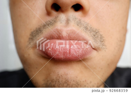 男性の唇は乾燥している 92668359