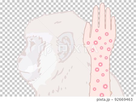 サル痘のイメージイラスト 92669463