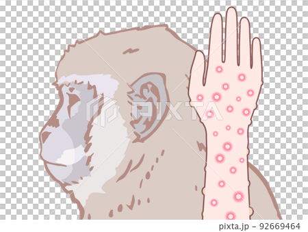 サル痘のイメージイラスト 92669464
