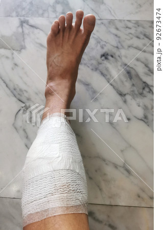 Patient left leg after cyst surgery covered by gauze pad and tape 92673474