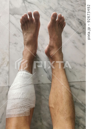 Patient legs after cyst surgery covered by gauze pad and tape Patient legs after cyst surgery covered by gauze pad and tape 92673492