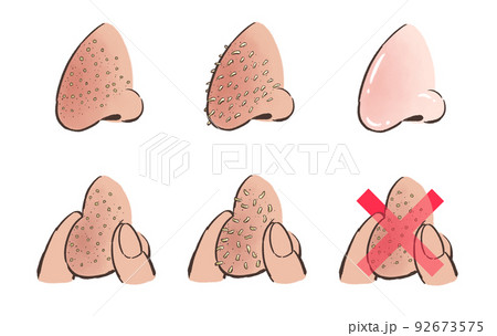 鼻の角栓のイラスト 92673575