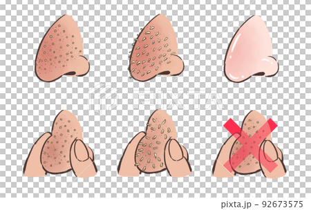 鼻の角栓のイラスト 92673575
