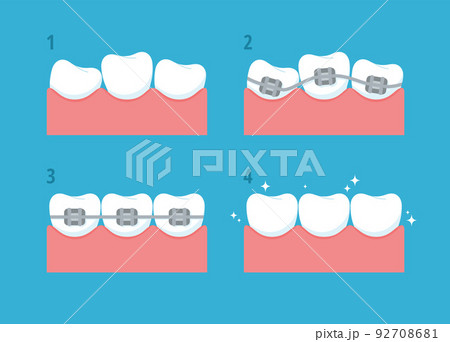 Correction of crooked teeth, a set of vector flat illustrations. Correction of crooked teeth, a set of vector flat illustrations. 92708681