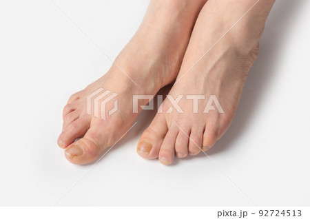 overgrown toenails need a pedicure. white woman feet with nails in need pedicure on white background. spa pedicure salon concept 92724513
