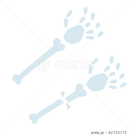 Healthy and sick hand. Broken bone. 92733775